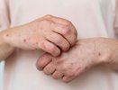 Во Владимире локализовали очаги кори в гимназии и детском саду