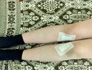 Владимирские врачи исправили тяжелую деформацию ног у 13-летнего мальчика