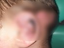 Врачи Владимирской ОДКБ спасли ухо 13-летнему мальчику после аварии