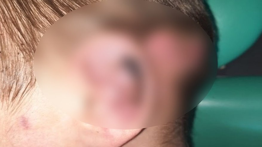 Главная картинка новости: Врачи Владимирской ОДКБ спасли ухо 13-летнему мальчику после аварии