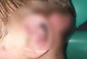 Миниатюра новости: Врачи Владимирской ОДКБ спасли ухо 13-летнему мальчику после аварии