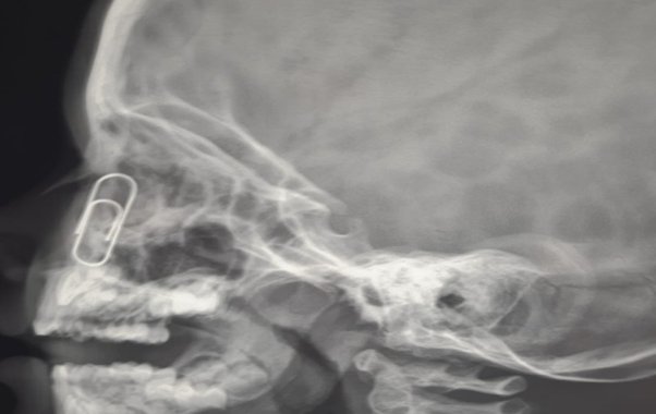 Владимирские врачи достали скрепку из носа четырёхлетнего ребёнка