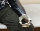 Жителю Владимирской области установили бионическую кисть стоимостью 3,3 миллиона рублей